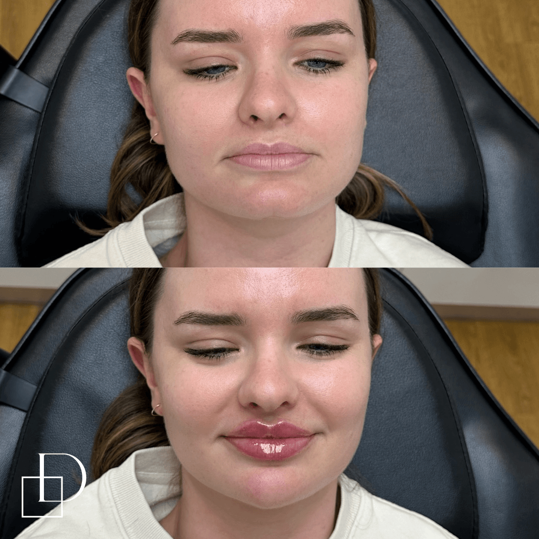 Before and after chin filler injections at Define Clinic Brisbane