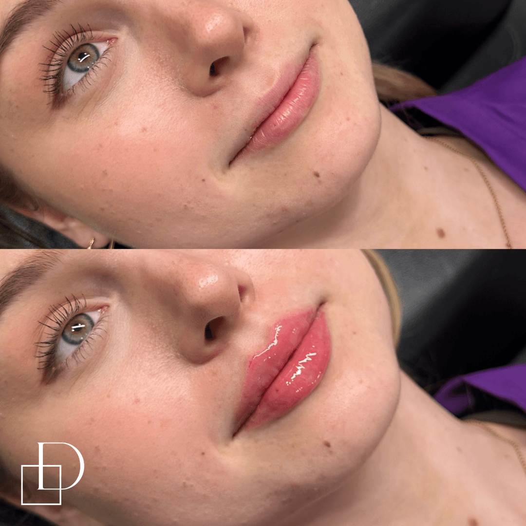 Before and after lip filler injections at Define Clinic Brisbane