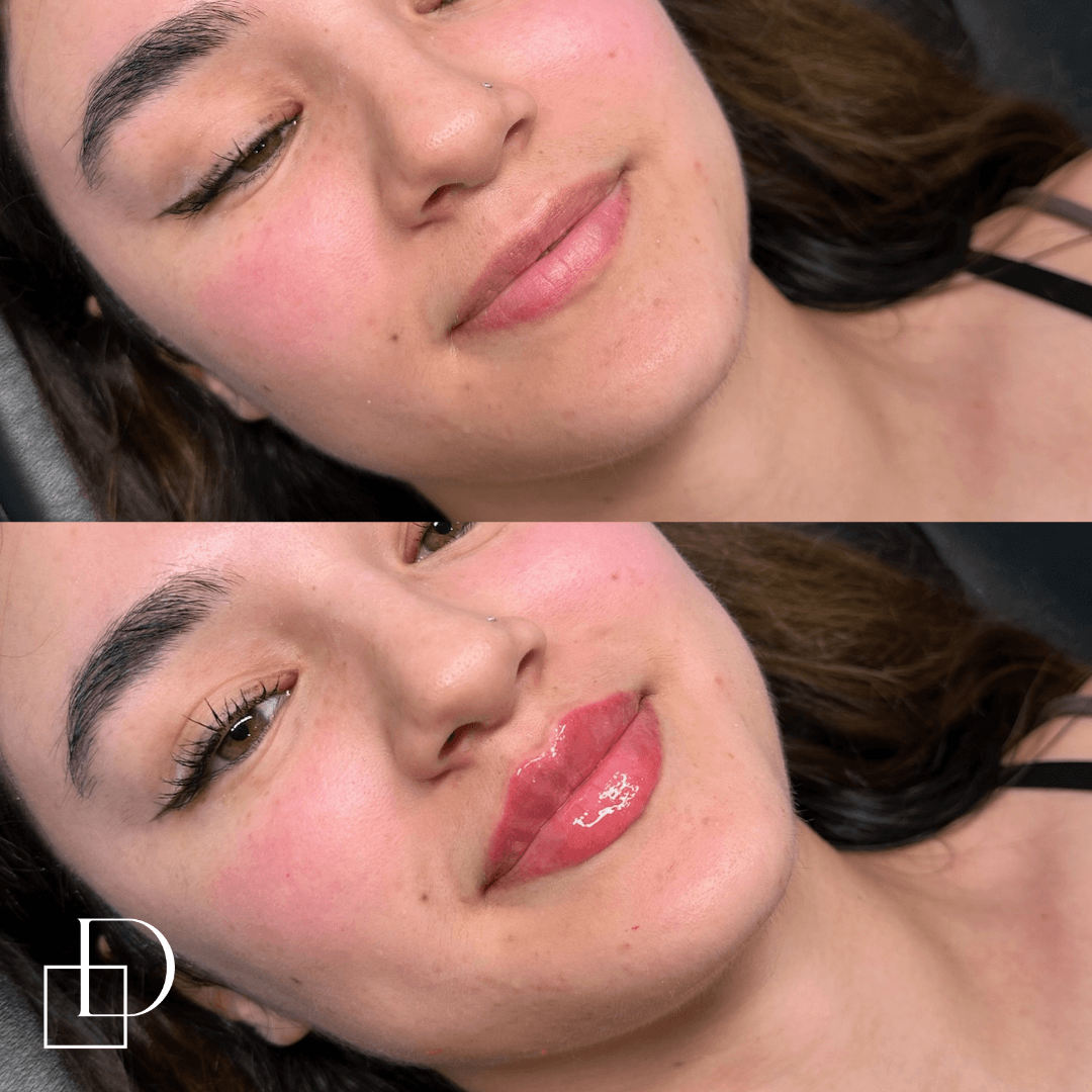 Before and after lip filler injections at Define Clinic Brisbane