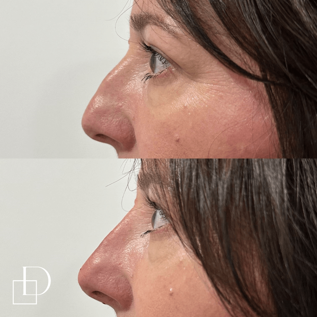 Before and after non-surgical rhinoplasty nose filler at Define Clinic Brisbane