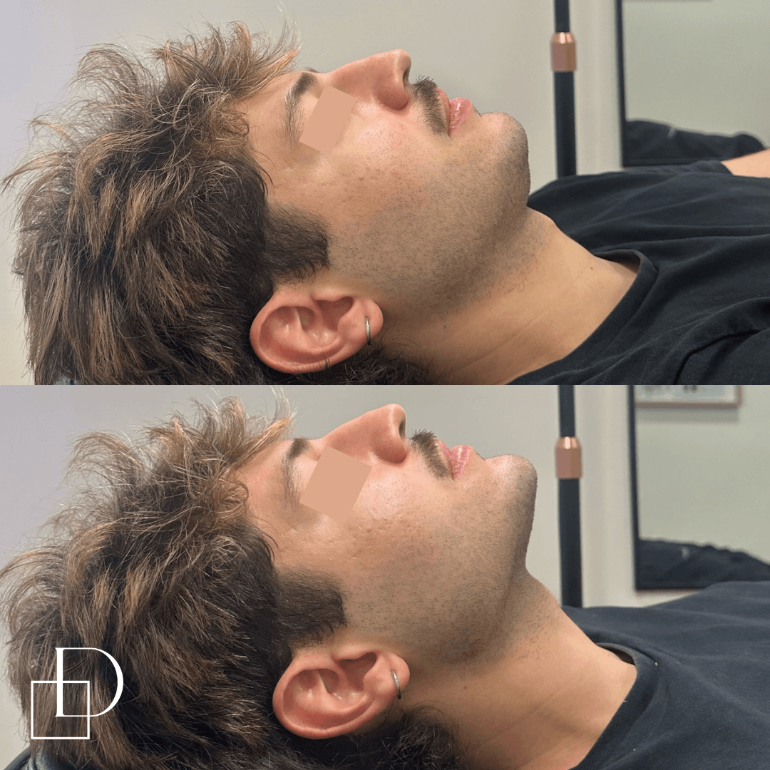 Before and after chin filler injections on male patient at Define Clinic Brisbane