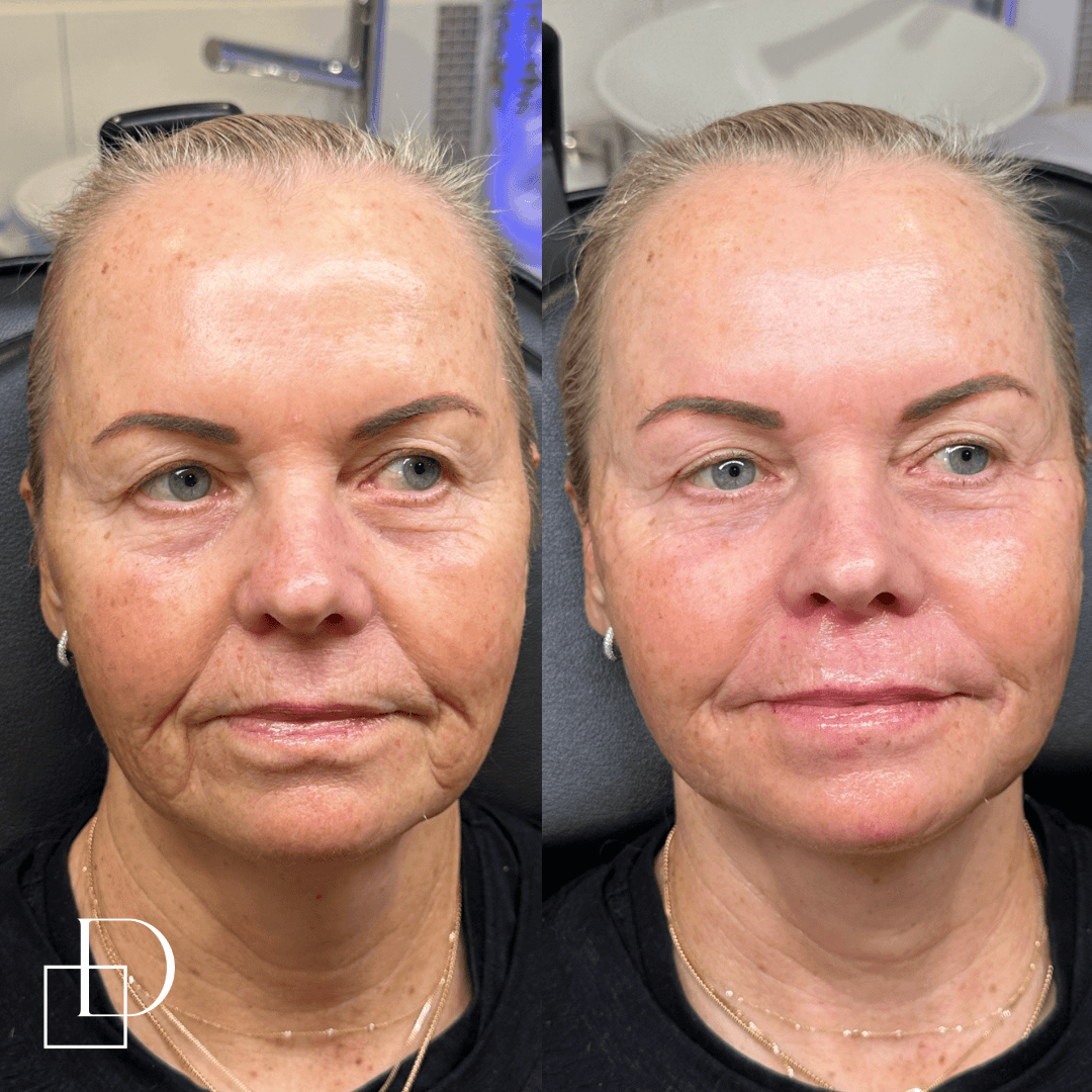 Before and after cosmetic dermal filler injections at Define Clinic Brisbane