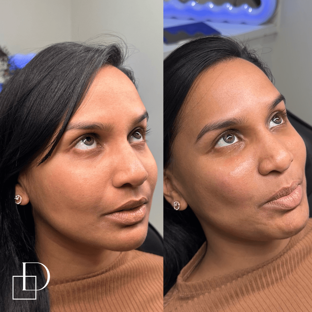 Before and after tear trough under eye filler injections at Define Clinic Brisbane
