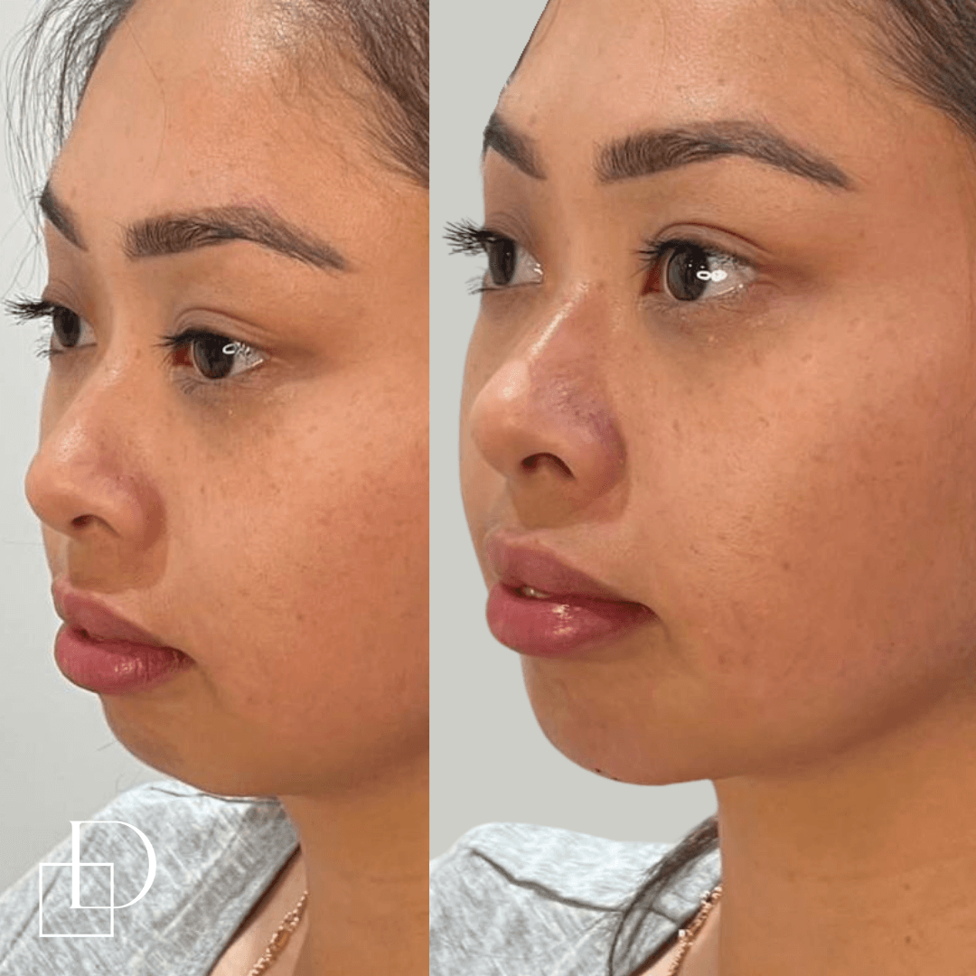 Before and after chin filler injections at Define Clinic Brisbane