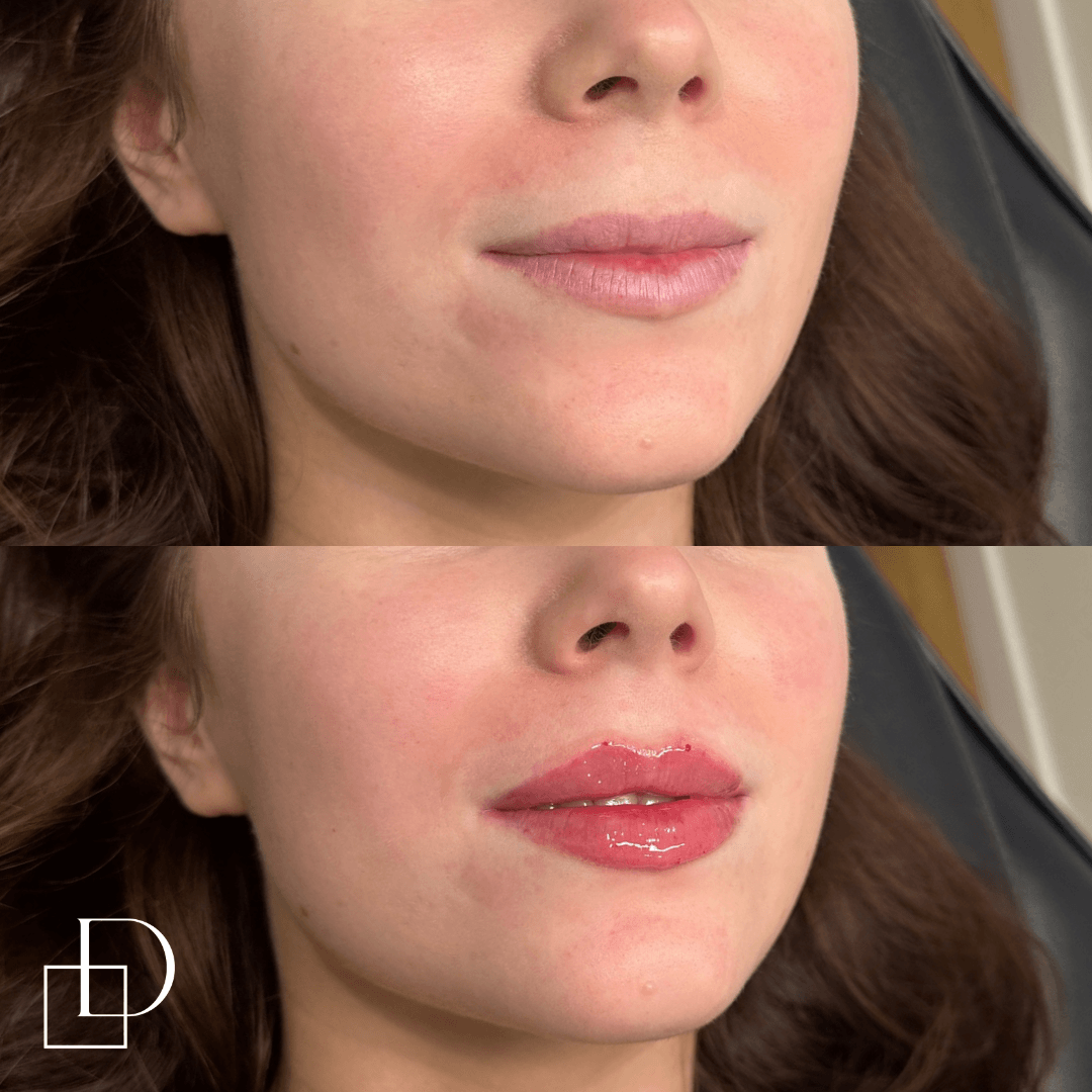 Before and after lip filler injections at Define Clinic Brisbane