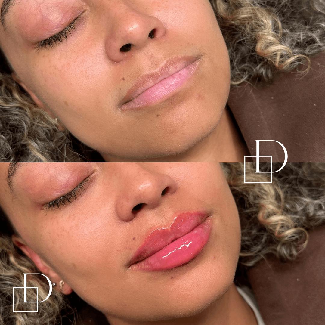 Before and after lip filler injections at Define Clinic Brisbane