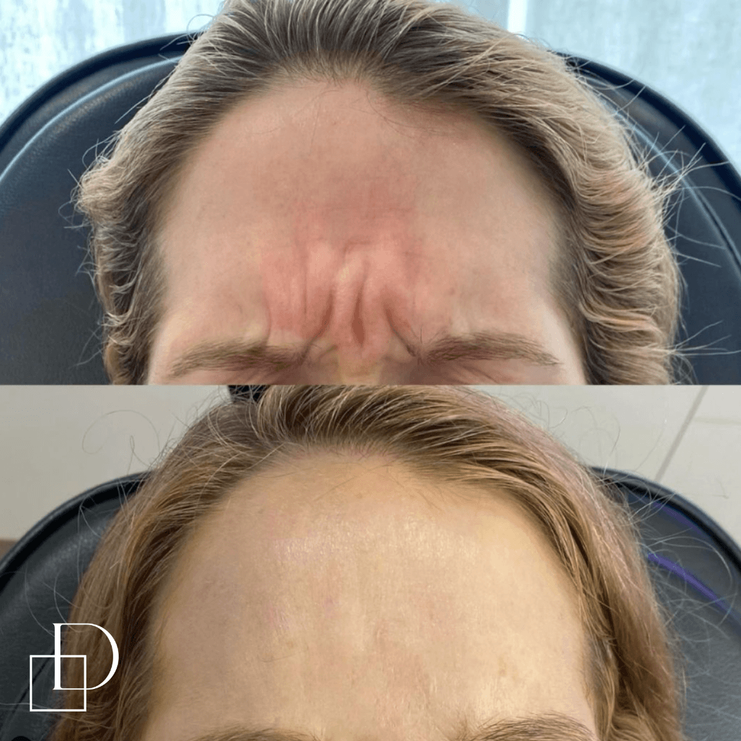 Before and after images of a woman showing a reduction in forehead wrinkles and smoother skin.