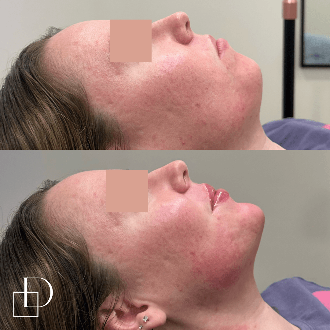 Before and after chin filler injections at Define Clinic Brisbane