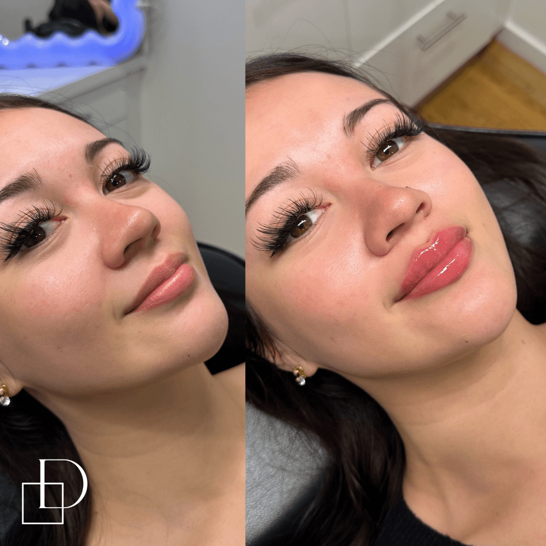 Before and after lip filler injections at Define Clinic Brisbane