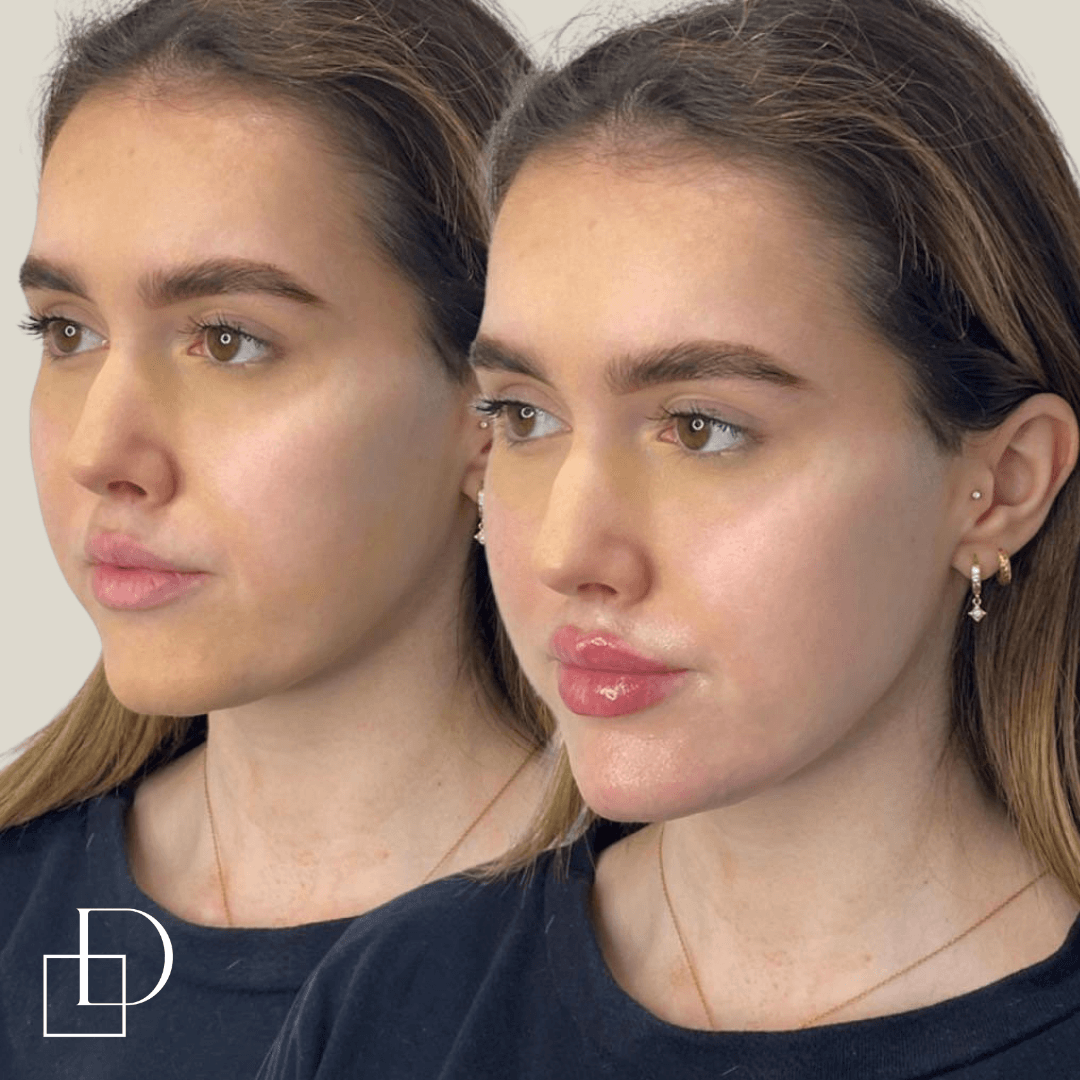 Before and after chin filler injections at Define Clinic Brisbane