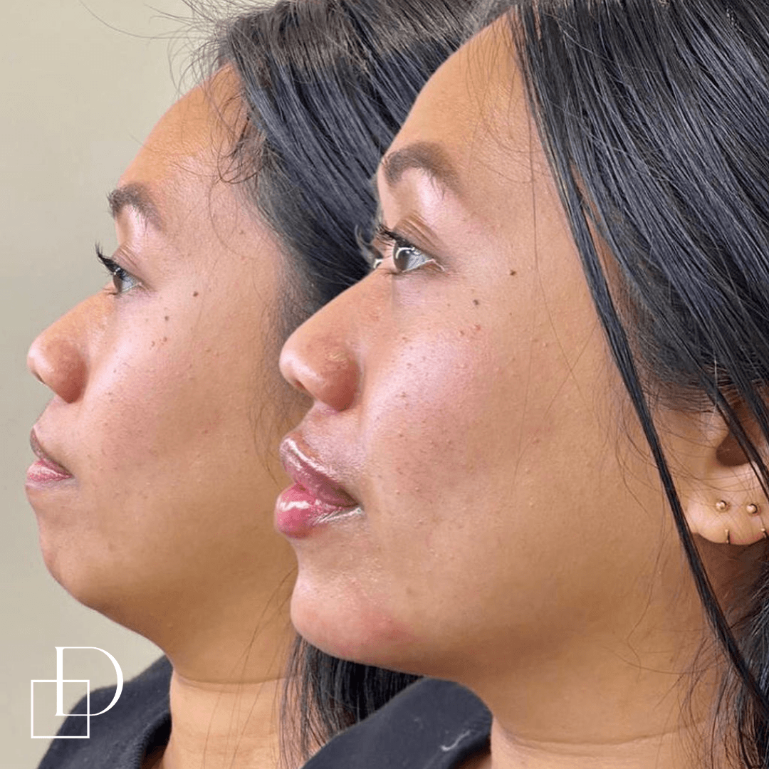 Before and after chin filler injections at Define Clinic Brisbane