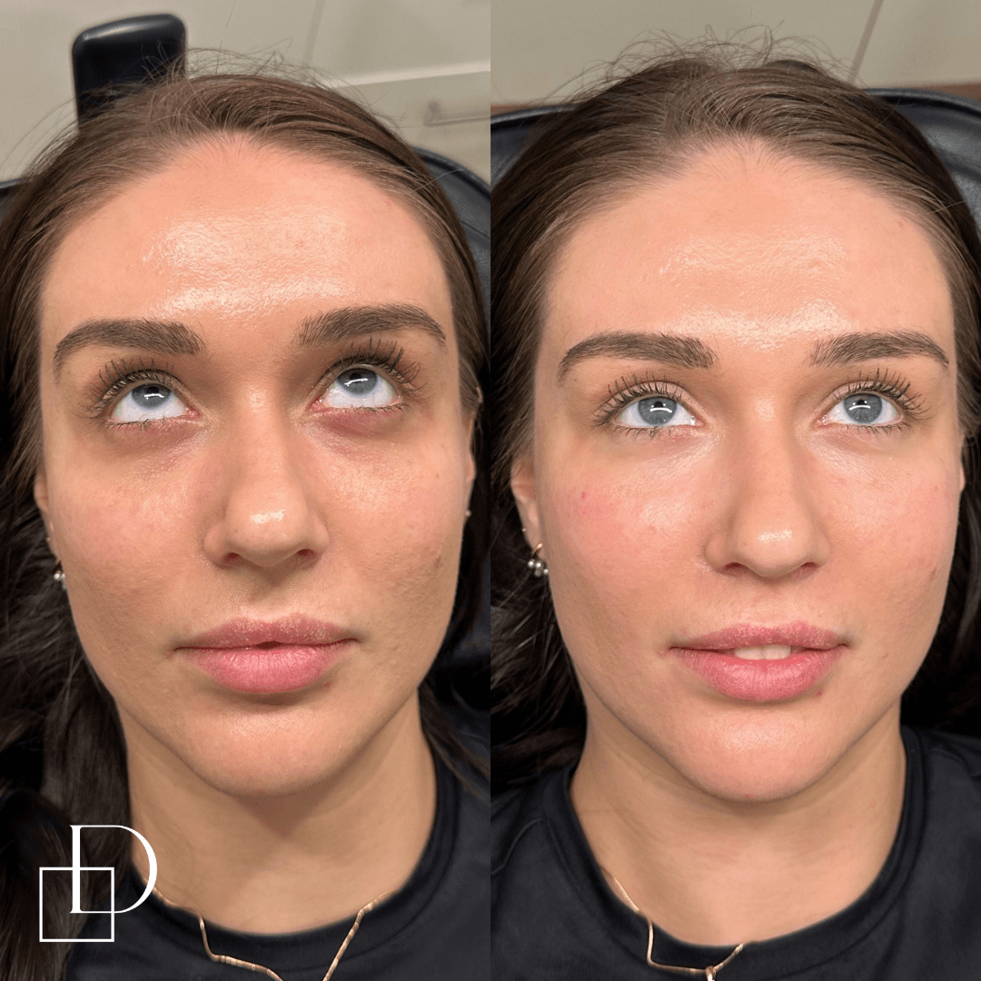 Before and after tear trough under eye filler injections at Define Clinic Brisbane