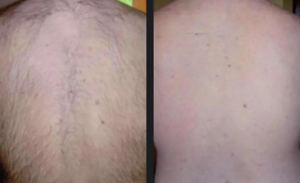 Nordlys Laser Hair Removal Before and After 6