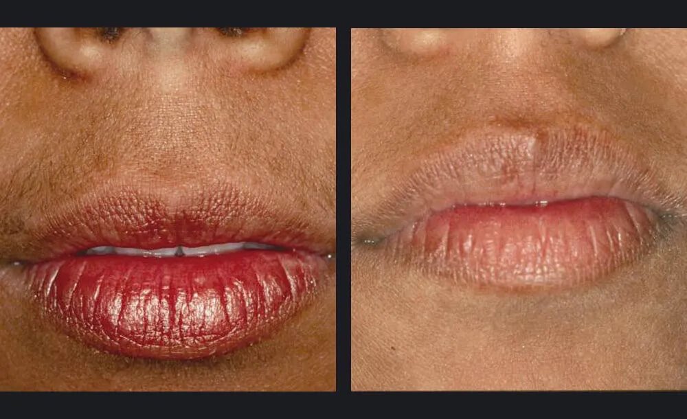 Skin Refining &amp; Rejuvenation with Nordlys Laser Treatment Before and After 1