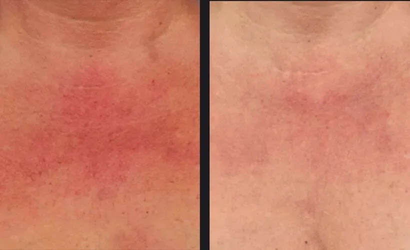 Skin Refining &amp; Rejuvenation with Nordlys Laser Treatment Before and After 3