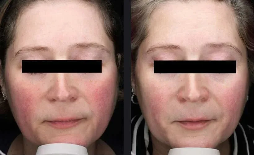 Skin Refining &amp; Rejuvenation with Nordlys Laser Treatment Before and After 4