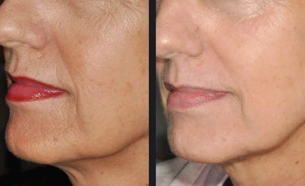 nordlys-skin-rejuvenation-sebastian-cintolesi-md-p1.jpg