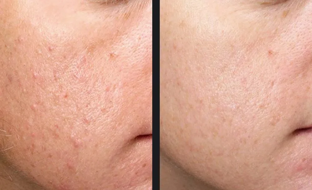 exceed-acne-scars-p2-mtderm.jpg.jpeg