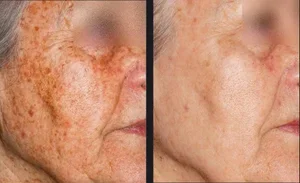 nordlys-pigmentation-guillermo-simon-md-p2.webp