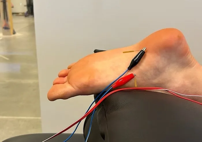 ESTIM Dry Needling