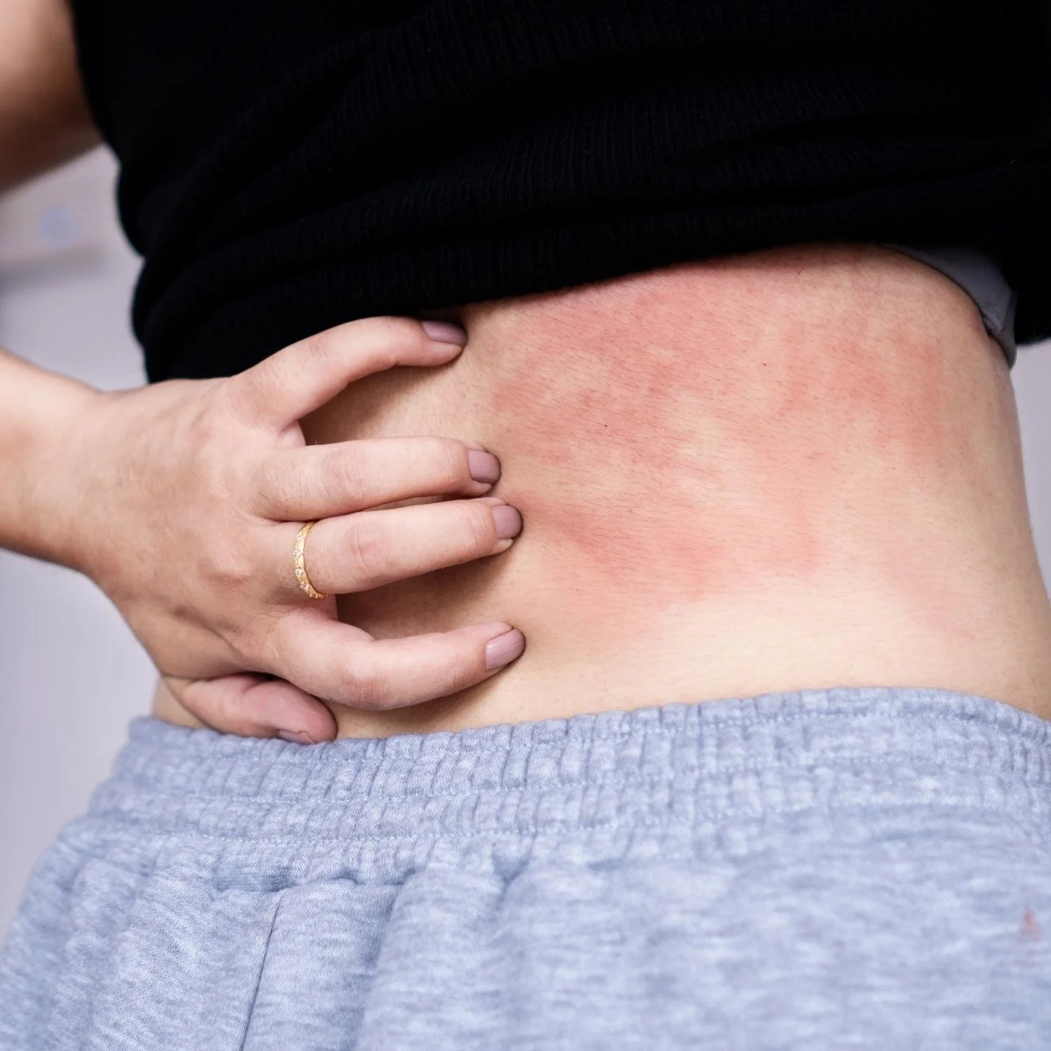 A person holding their side with a hand, showing redness and irritation on the skin near the waist.