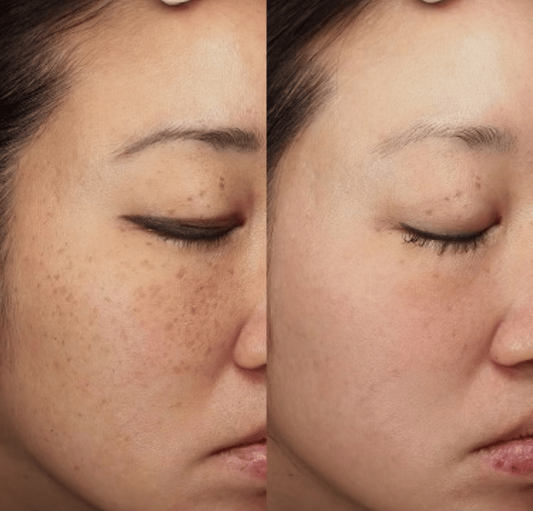  Pigmentation (Copy) (Copy)