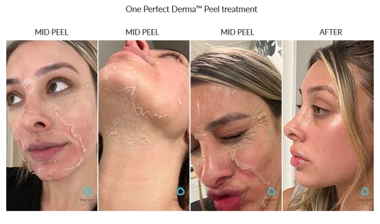 Sequence of four photos showing a woman applying and removing a facial peel or mask, highlighting her face and neck.