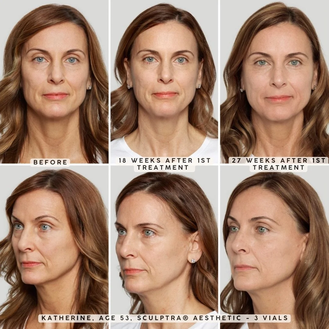 Side-by-side photos showing a woman's facial aesthetic improvements over 27 weeks after treatment with Sculptra®, a 3-vial course, with labeled stages: before, 18 weeks after, and 27 weeks after; she is 53 years old and the photos highlight changes in facial volume and skin texture.