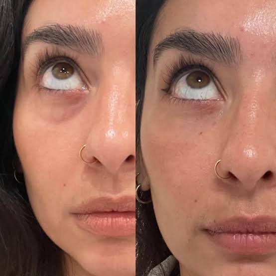 Side-by-side comparison of woman's face showing reduced under-eye dark circles and improved skin texture.