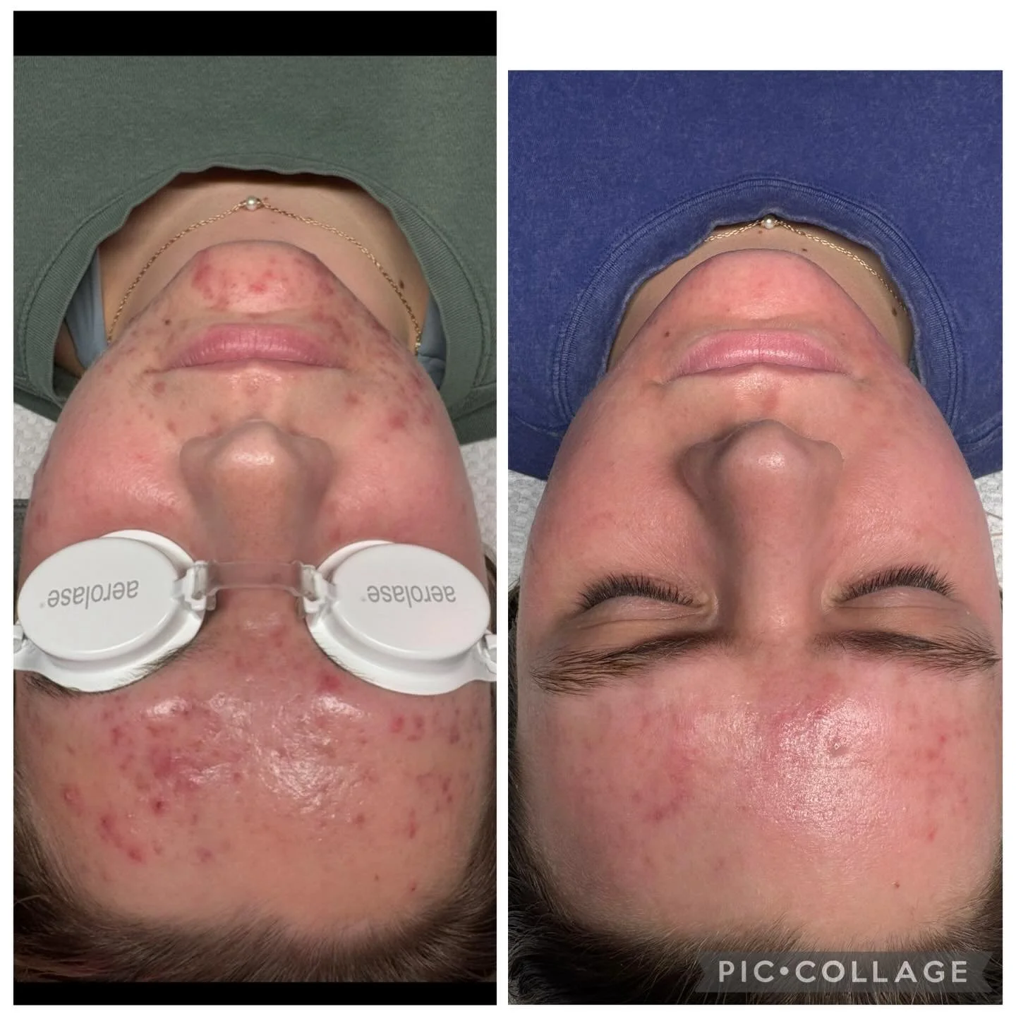 clear skin is possible with the right plan + consistency ✨ 

so proud of my sweet client who trusted the process and put in the work! the results speak for themselves 🧚💖