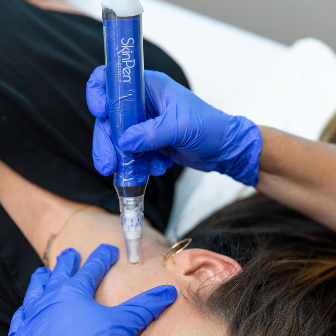 Microneedling with SkinPen 