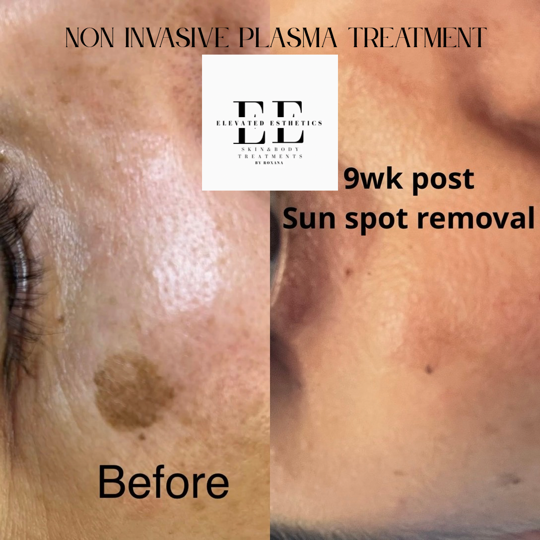 non invasive plasma treatment.PNG