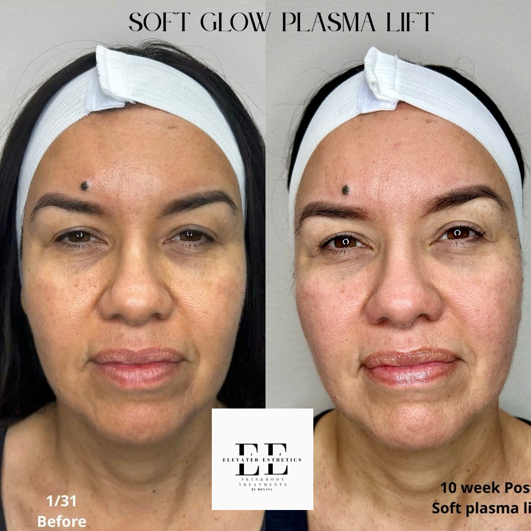 Soft glow plasma lift.PNG