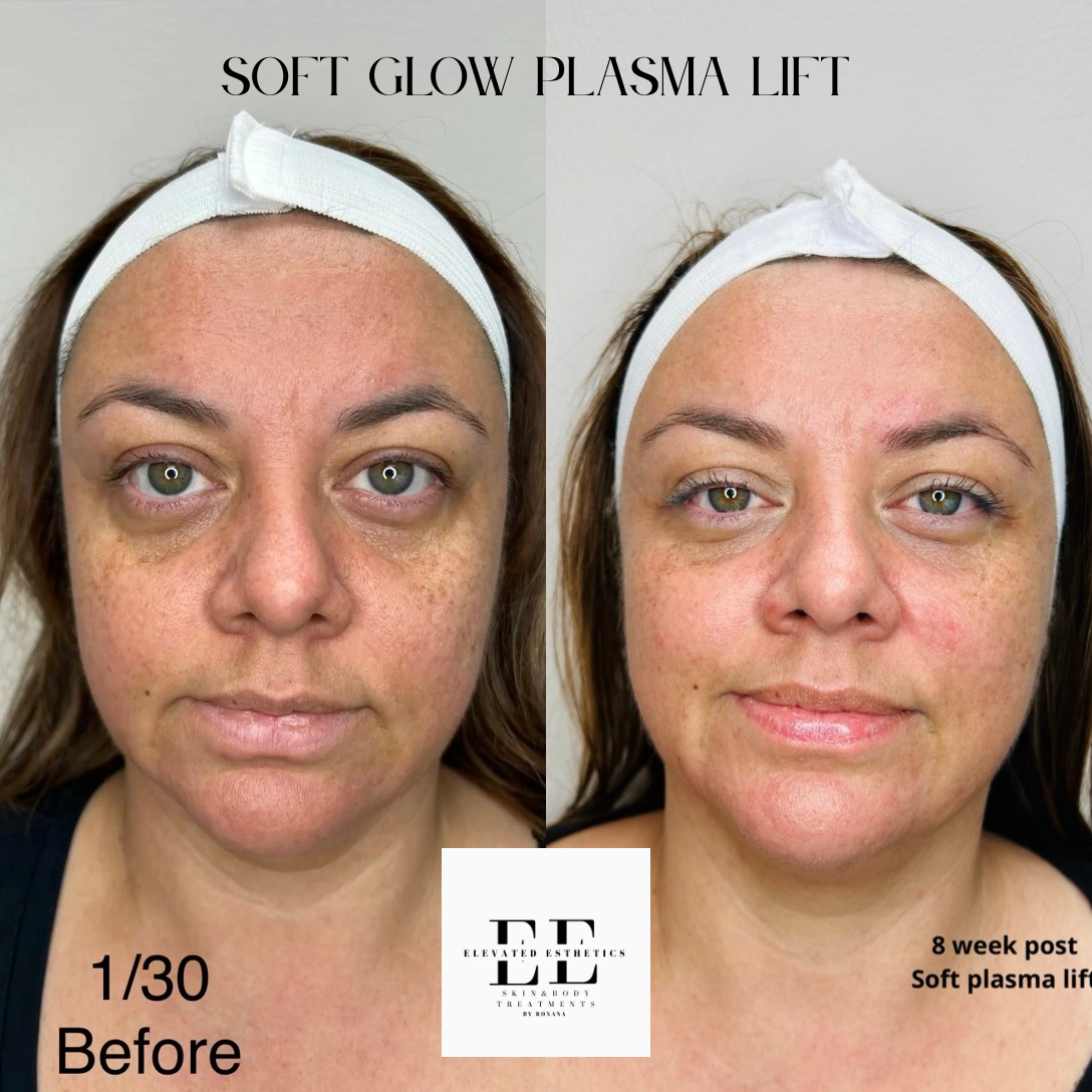 Soft glow plasma lift (1).PNG
