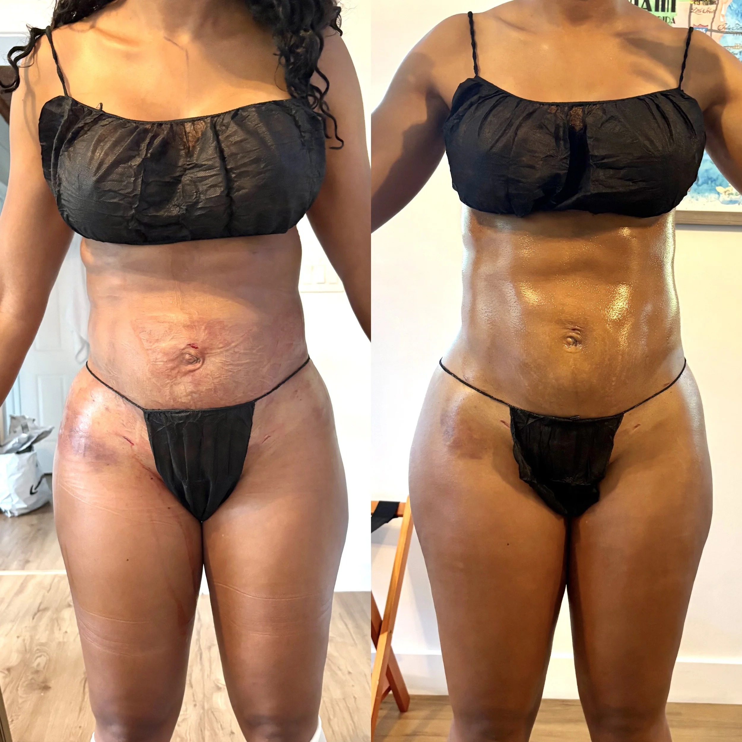 Side-by-side comparison of a woman's midsection before and after body transformation, showing improvements in skin tone, texture, and overall appearance.