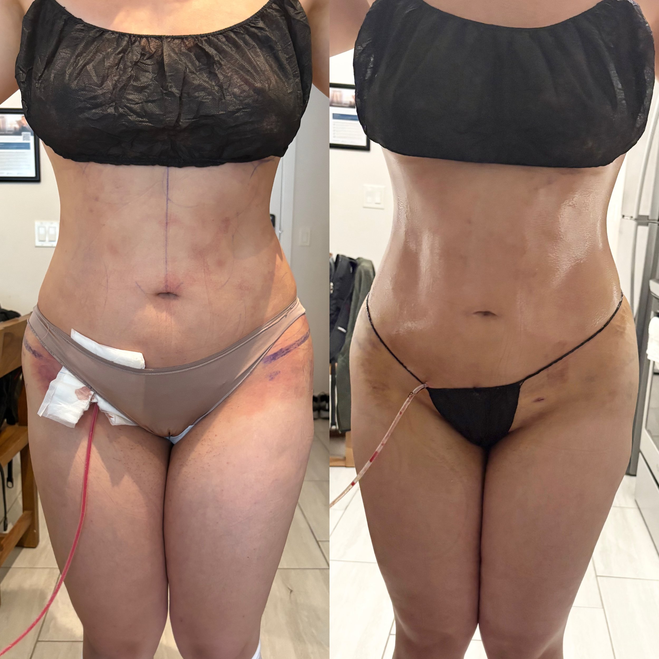 Side-by-side comparison of a woman before and after a surgical procedure, showing changes in abdominal and thigh area with medical markings and drainage tubes.
