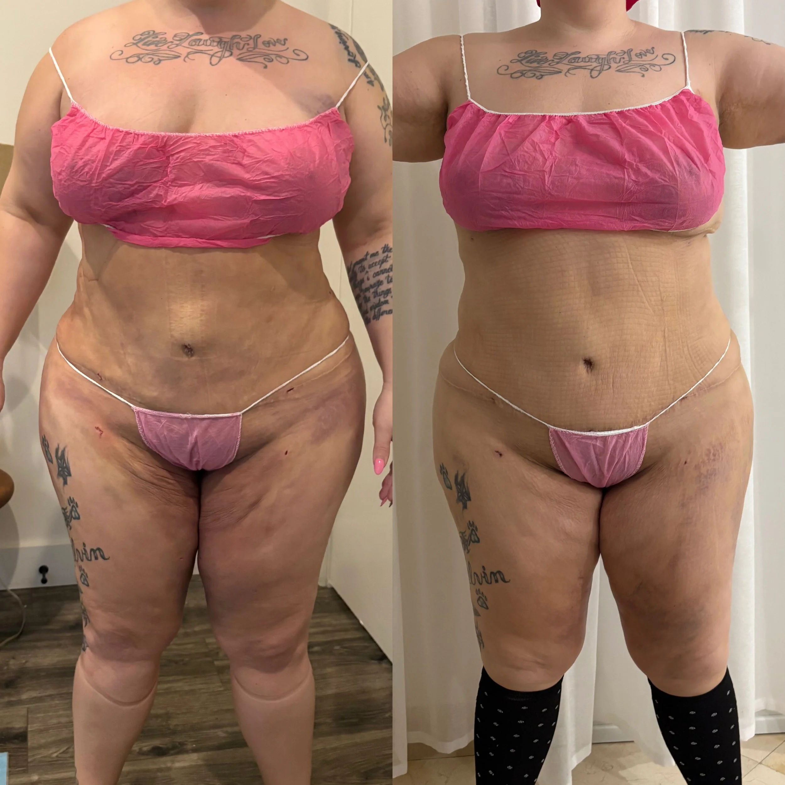 Side-by-side comparison of a woman’s abdominal area before and after a transformation, wearing a pink top and undergarments, with tattoos on her left thigh and right arm.