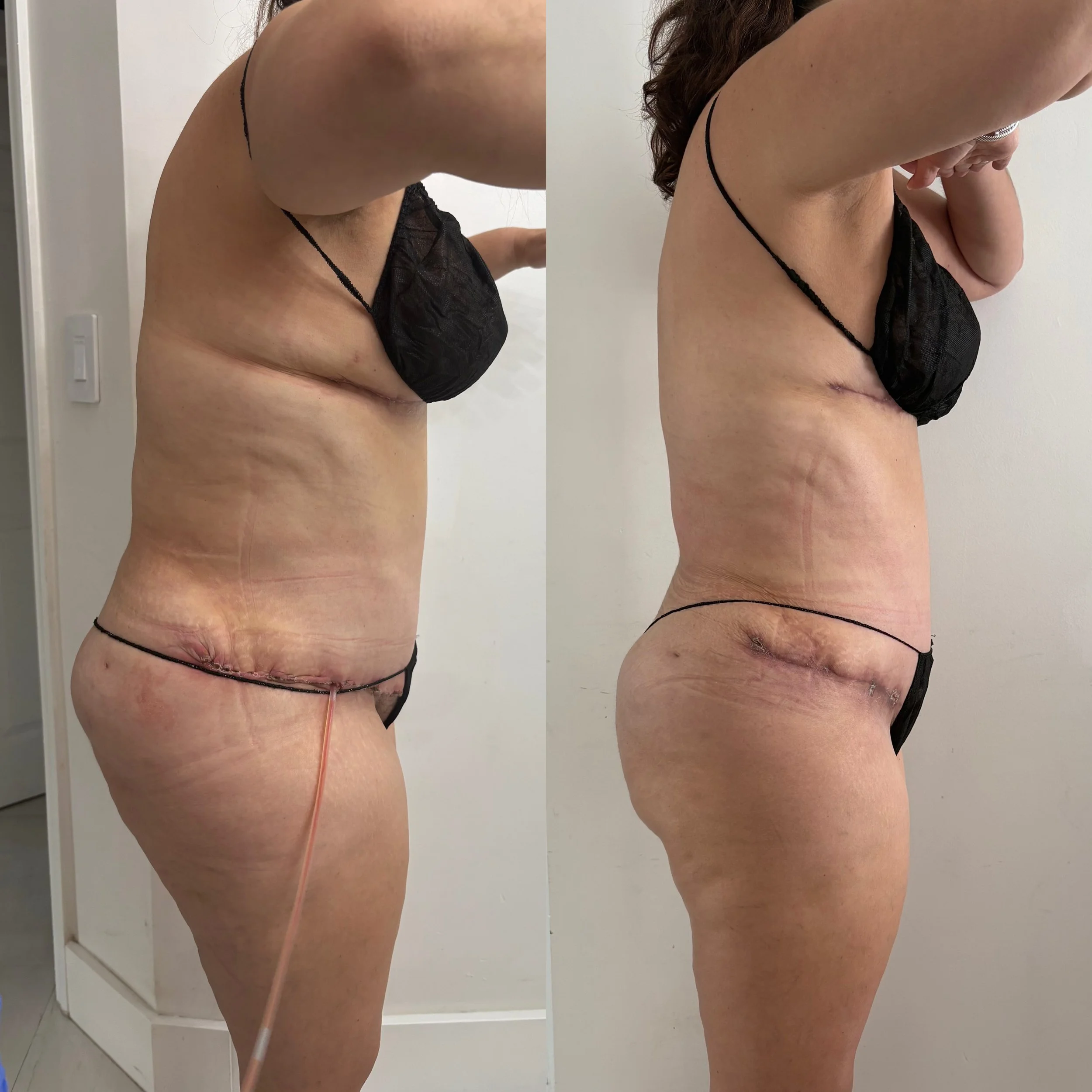 Side-by-side comparison of a woman's torso before and after surgery, showing a scar and healing process.