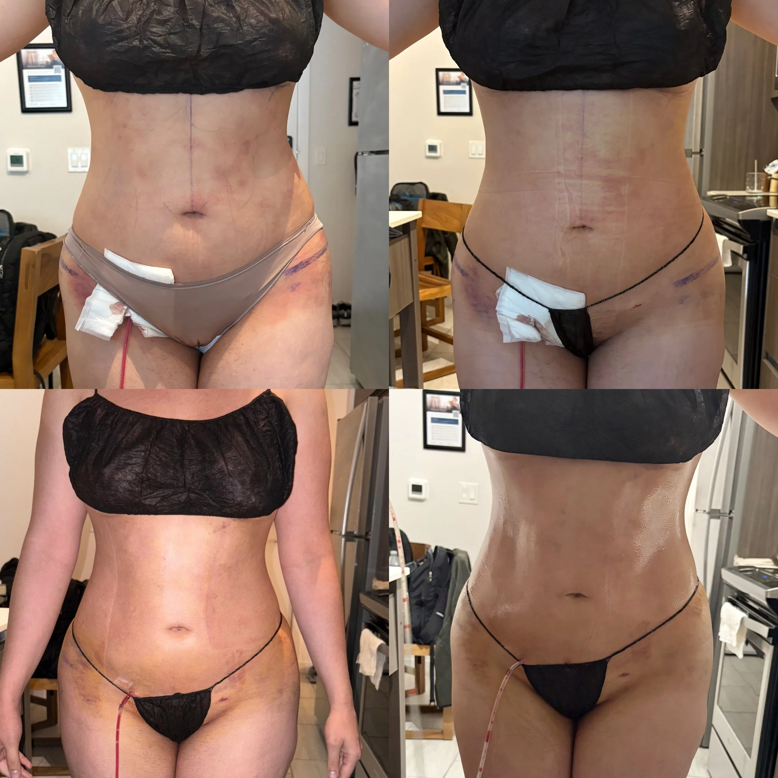 Series of before and after photos showing a woman's abdomen and waist area, highlighting changes in skin tightness, with visible medical markings and surgical drains.
