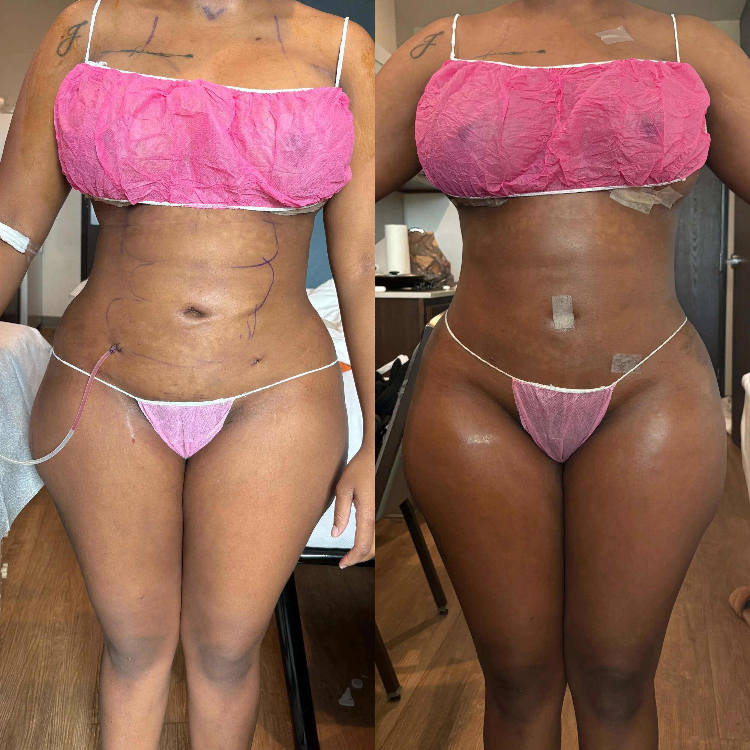 Side-by-side comparison of a woman's torso before and after a medical procedure, showing a reduction in abdominal size and improved skin tone, with surgical markings and medical tape visible.