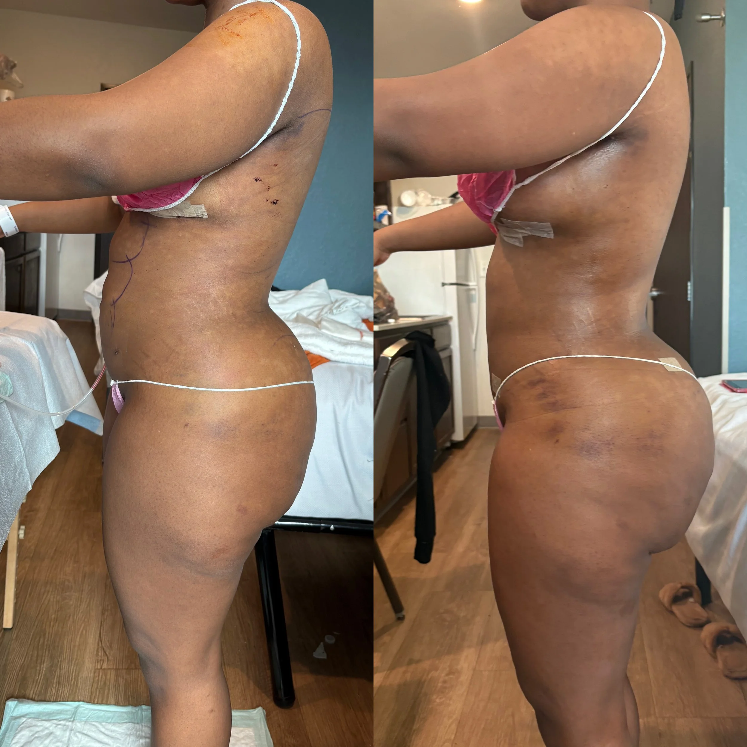 Side view of a woman in a hospital room before and after cosmetic surgery, showing changes in her waist and hip area with markings for surgery.
