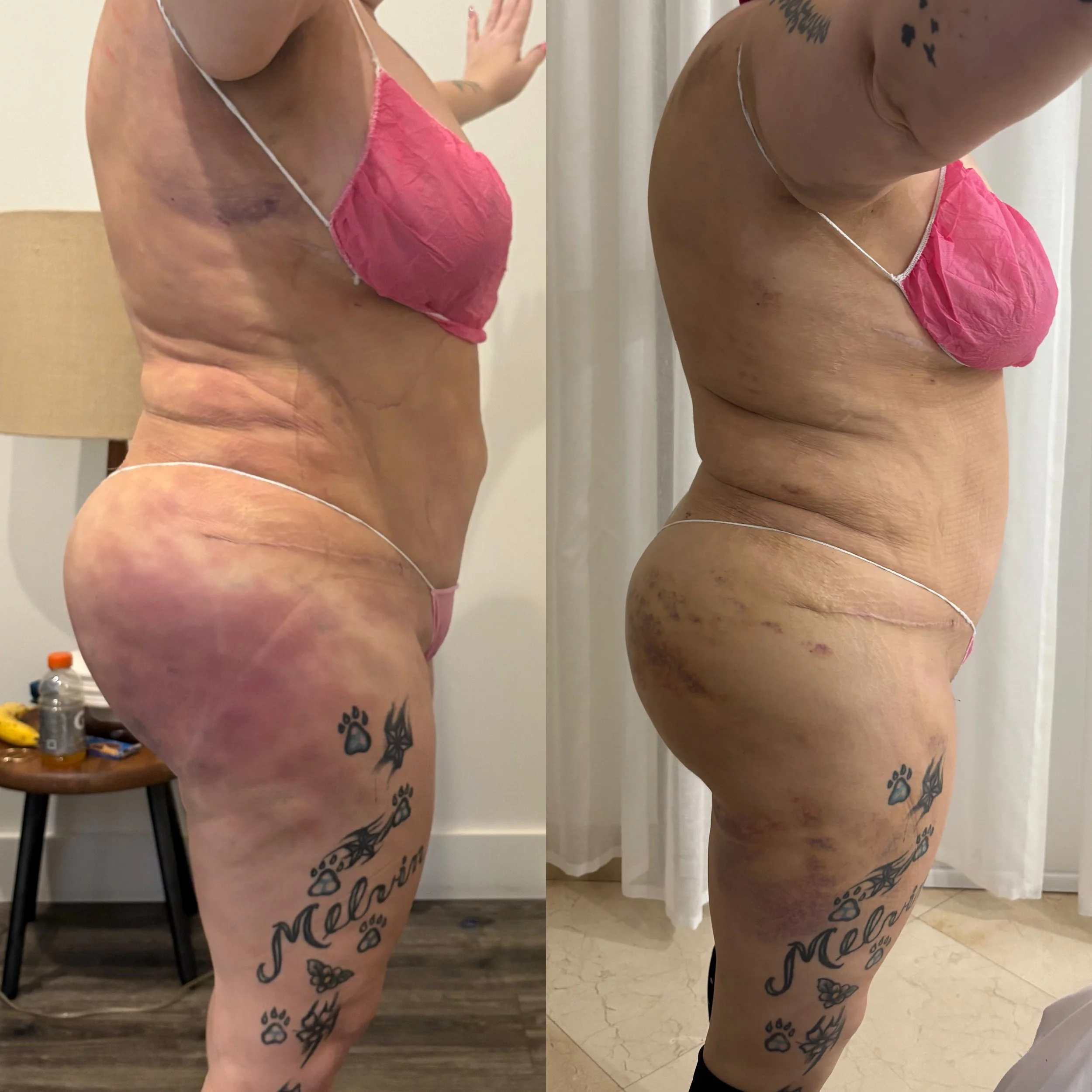 Side-by-side comparison of a woman's body before and after weight loss or cosmetic procedures, showing significant reduction in body fat and loose skin, with tattoos on the thigh reading 'Melanie' and accompanied by paw prints and a butterfly.