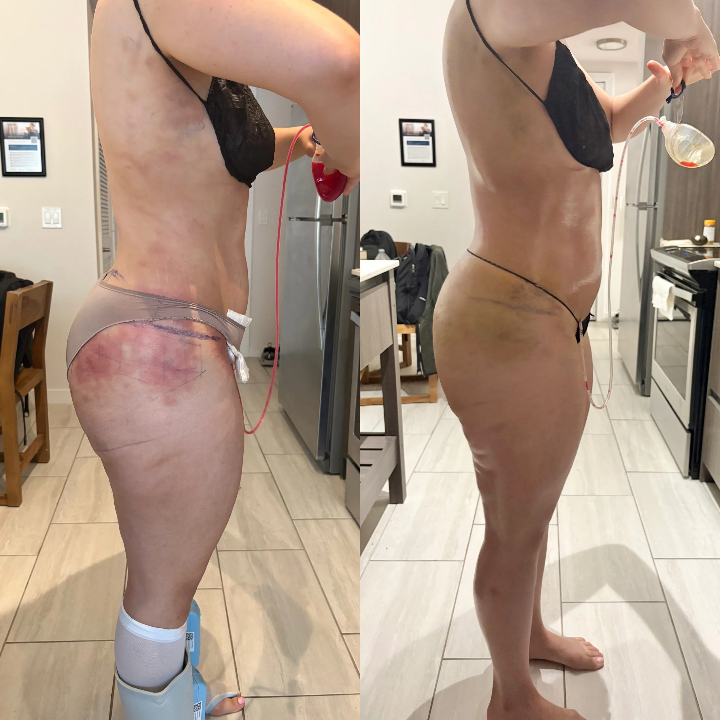 Side-by-side photos of a woman showing before and after recovery from surgery. The left image shows her with swelling, bruising, and surgical markings around her abdomen and buttocks, wearing beige underwear and medical compression device on her foot