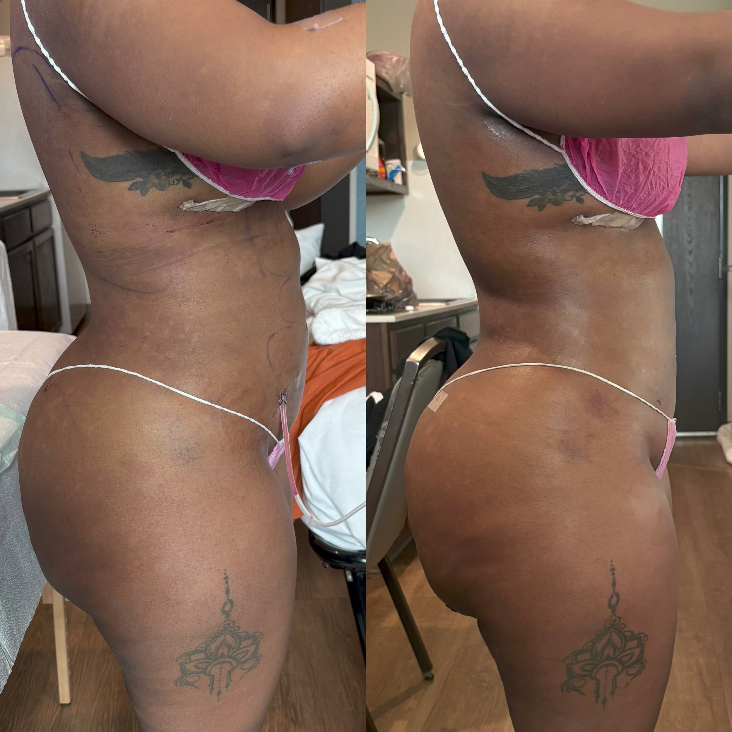 Side-by-side comparison of a person's midsection before and after a cosmetic procedure, showing changes in skin appearance and contouring.