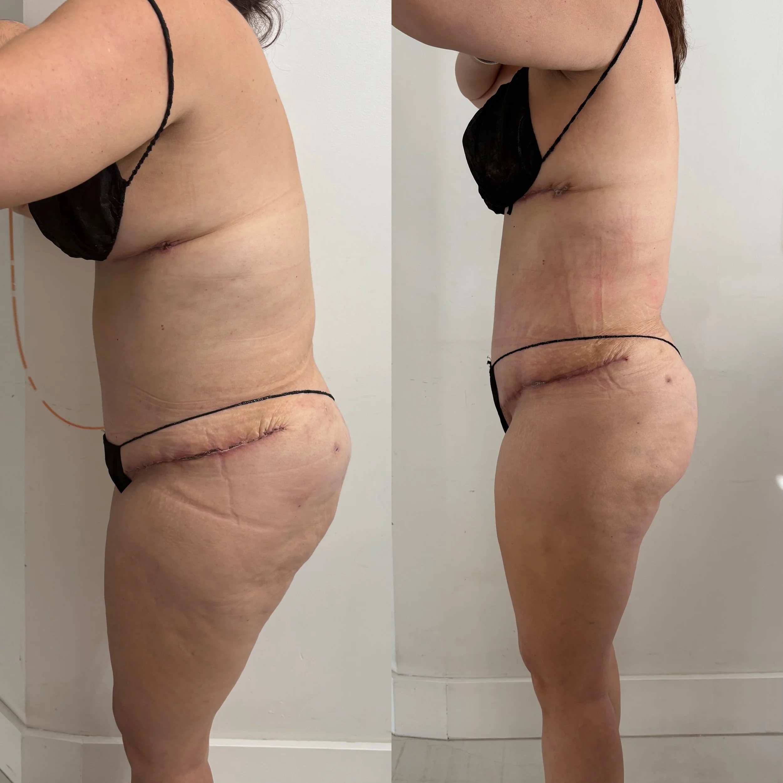 Side-by-side comparison of a woman's body before and after weight loss or body transformation, showing reduced size and improved skin appearance.