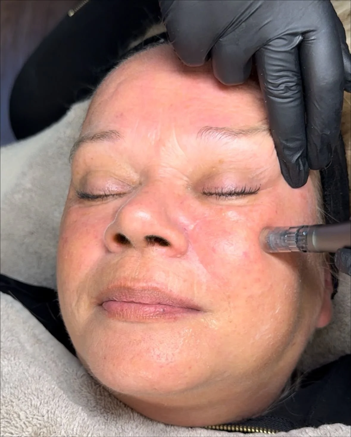 SKIN NEEDLING