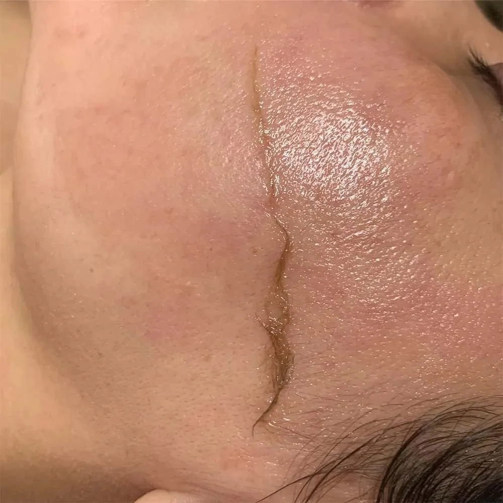 derma planing