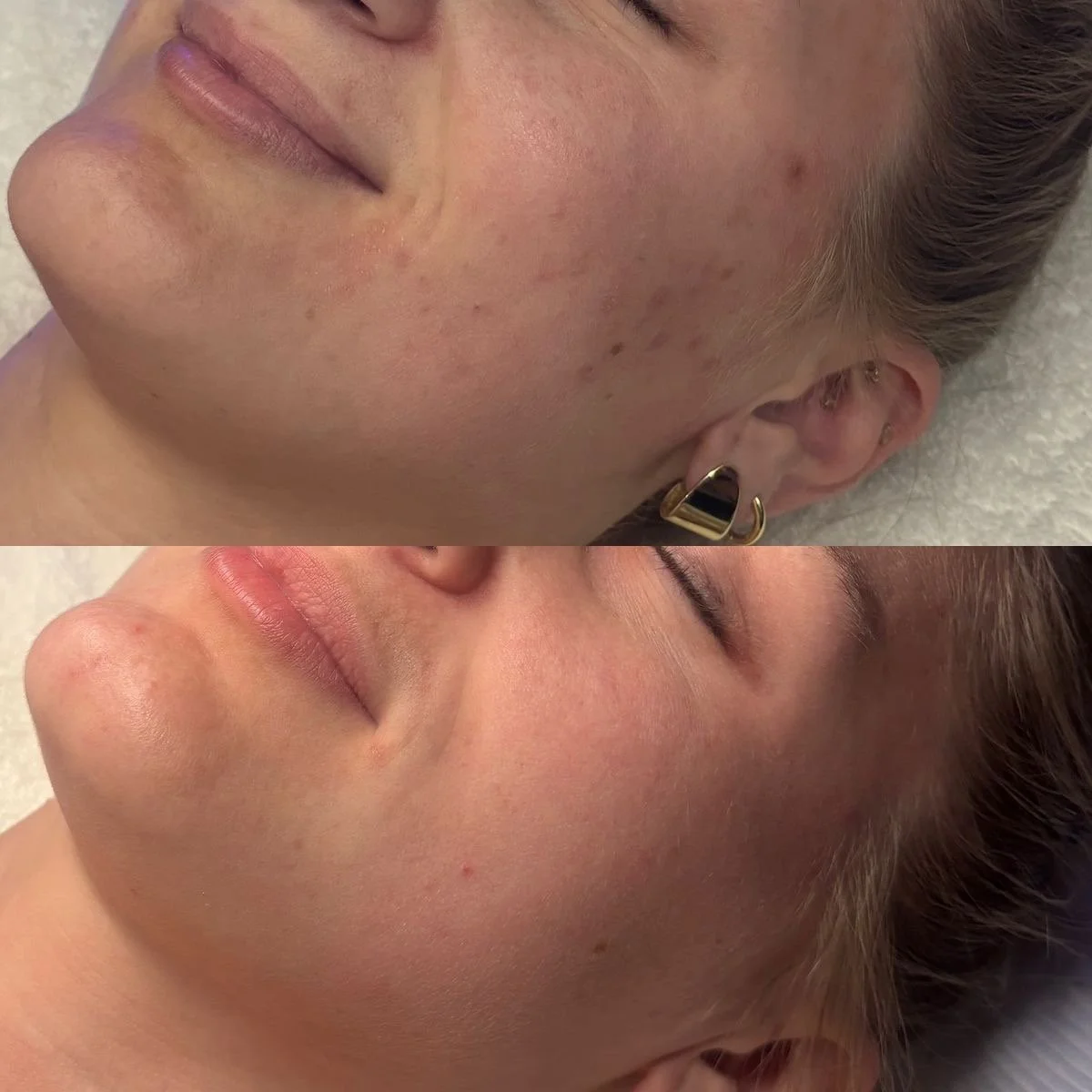 Chemical Peel Ctrl Alt Skin