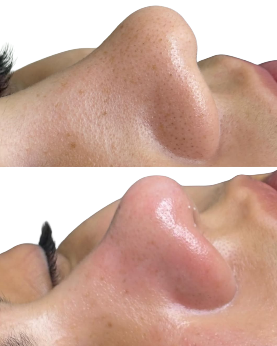 hydra facial ctrl alt skin