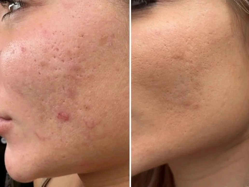 microneedling